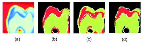 Tooth segmentations